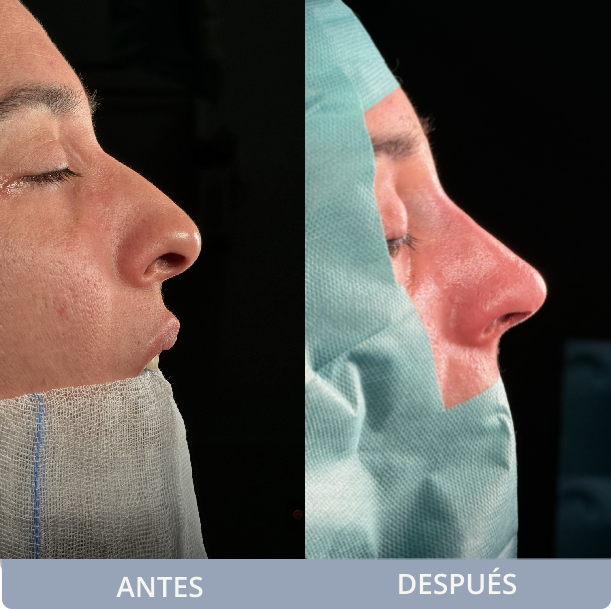 Antes y después rinoplasria sarrià