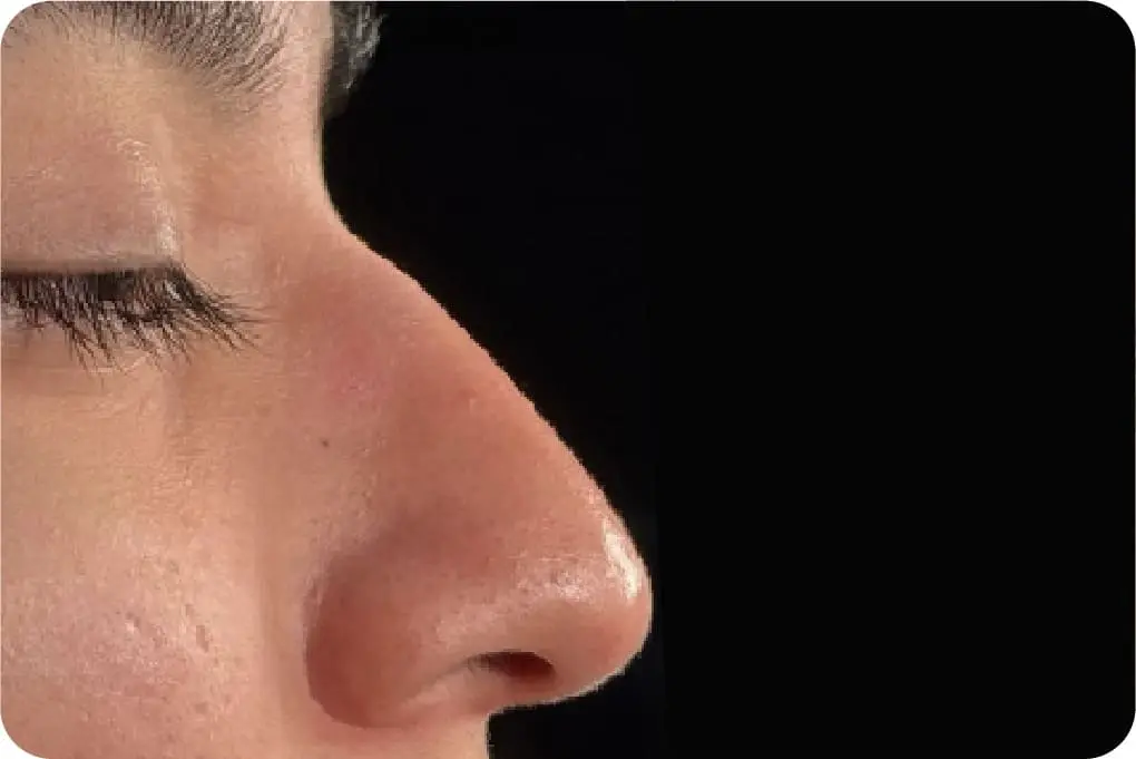 rinoplastia-antes