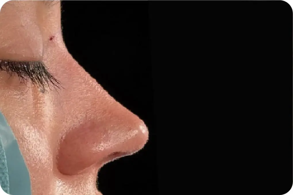 rinoplastia-despues