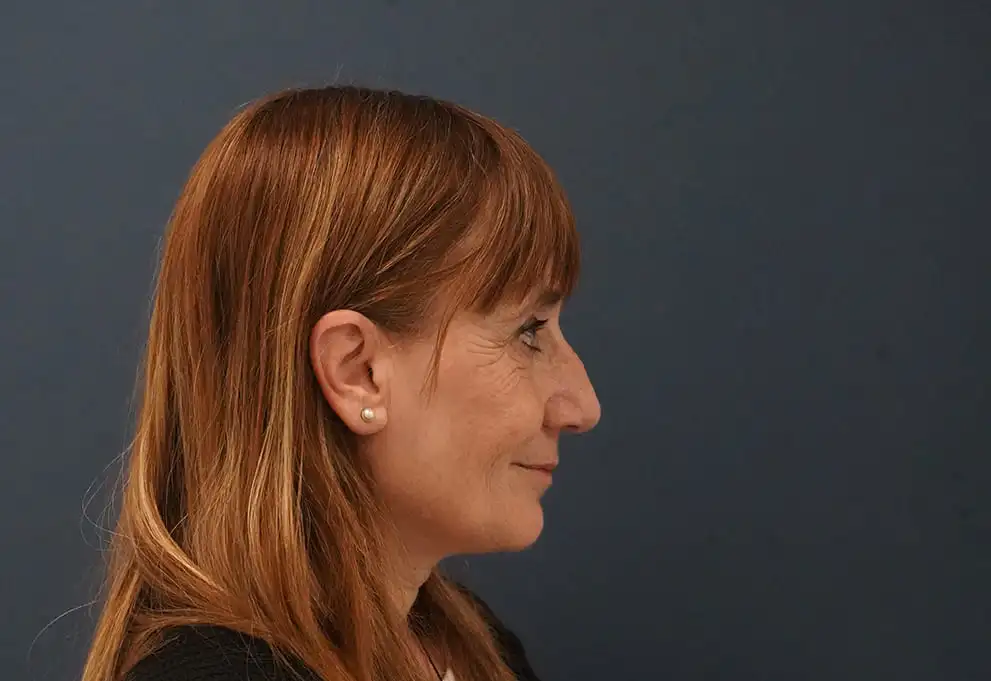 Rinoplastia caso-A-antes