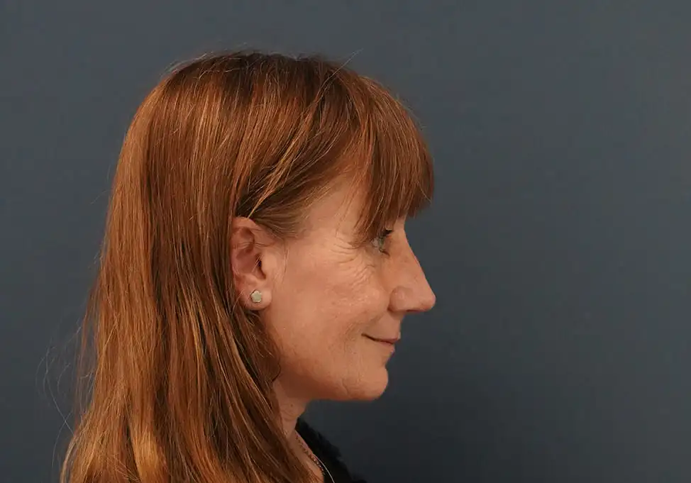 Rinoplastia caso-A-después