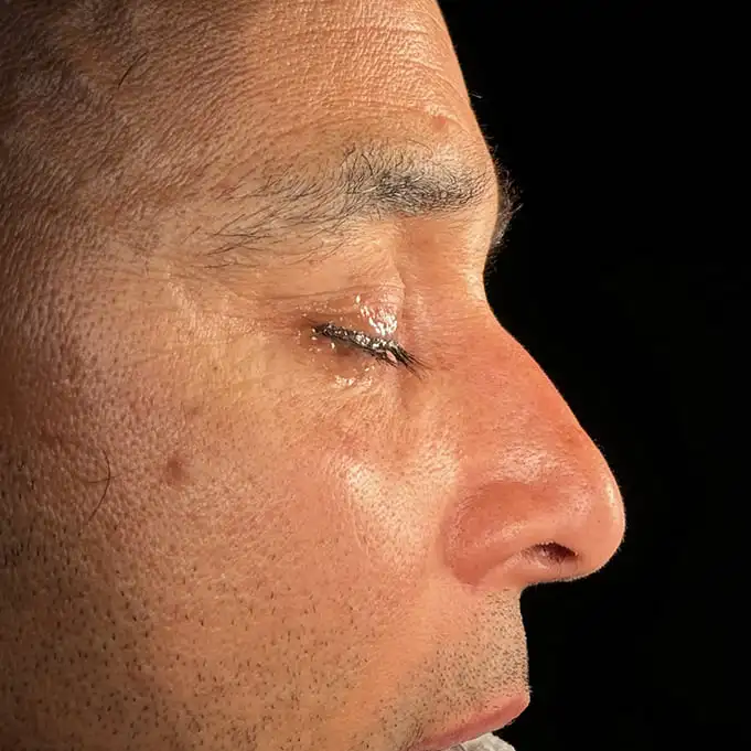 Rinoplastia caso-B-antes