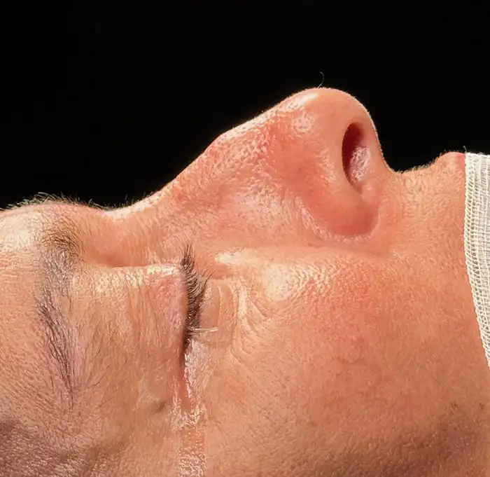 Rinoplastia caso-C-antes
