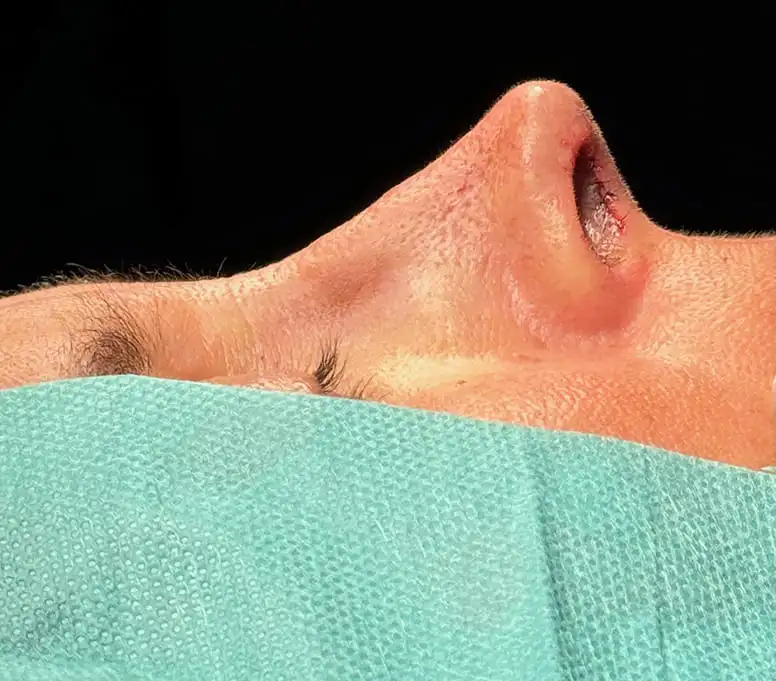 Rinoplastia caso-C-después
