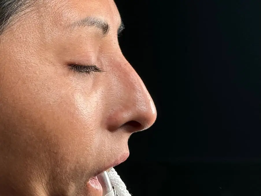 Rinoplastia caso-D-antes