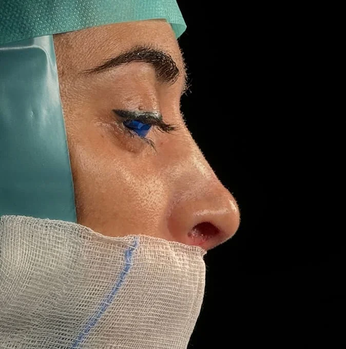 Rinoplastia caso-E-antes
