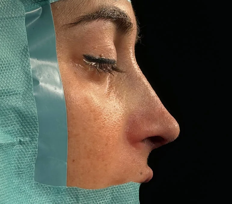 Rinoplastia caso-E-después