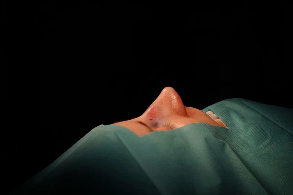 Rinoplastia caso-F-después
