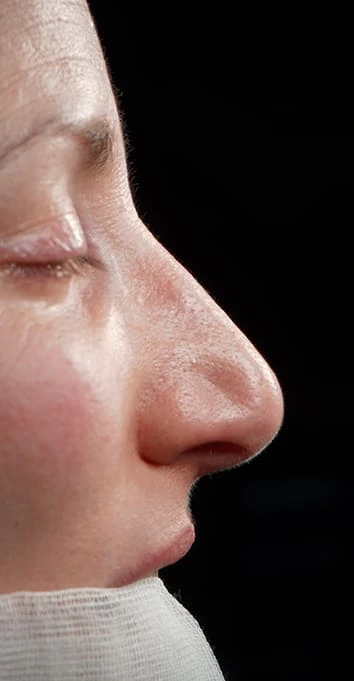 Rinoplastia caso-G-antes