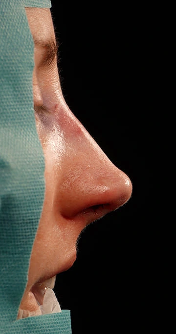 Rinoplastia caso-G-después