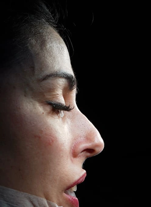 Rinoplastia caso-H-antes