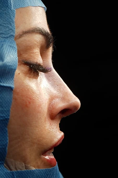 Rinoplastia caso-H-después