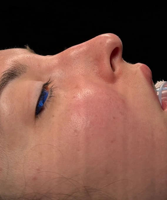 Rinoplastia caso-I-antes