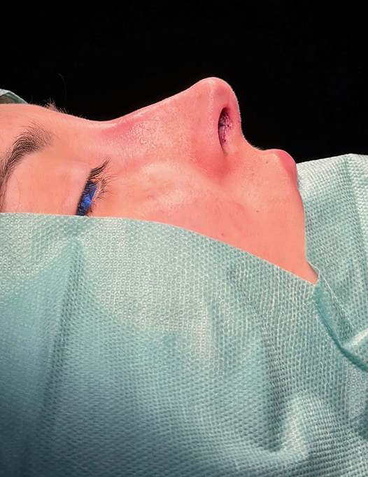 Rinoplastia caso-I-después