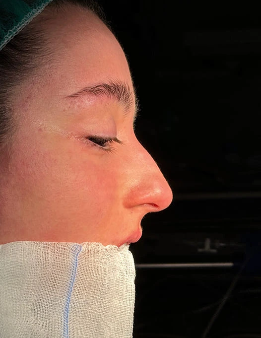 Rinoplastia caso-J-antes