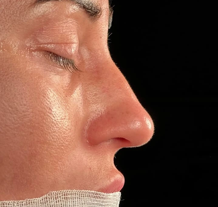 Rinoplastia caso-K-antes