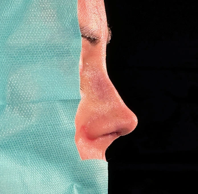 Rinoplastia caso-K-después