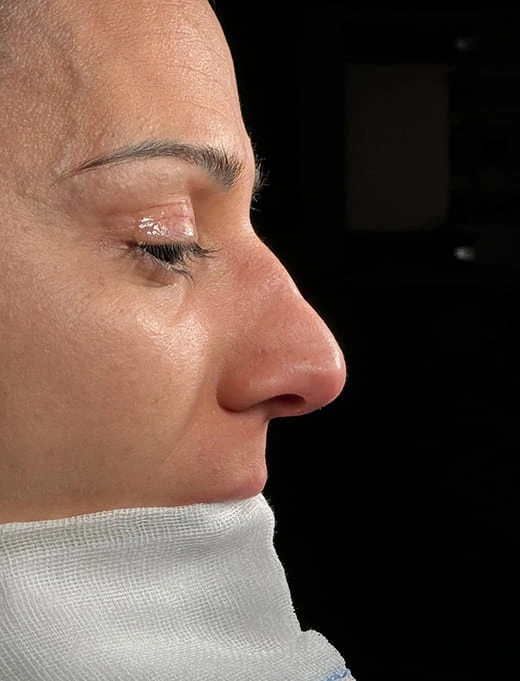 Rinoplastia caso-L-antes