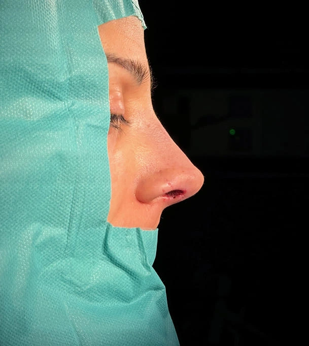 Rinoplastia caso-L-después
